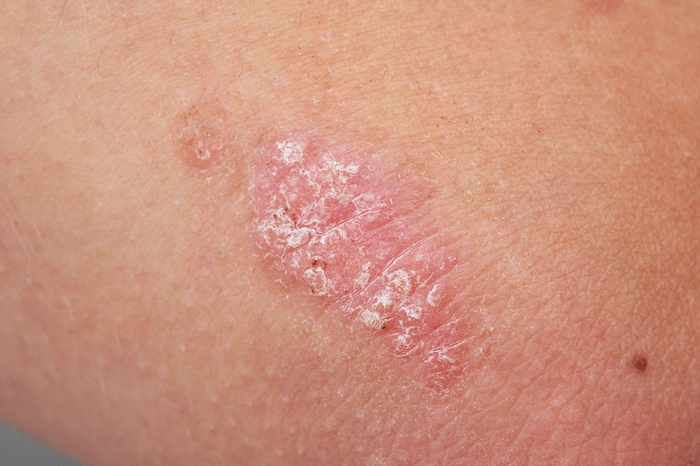 PUVA y NB-UVB siguen siendo un tratamiento antipsoriásico eficaz; Investigación de mayo de 2021
