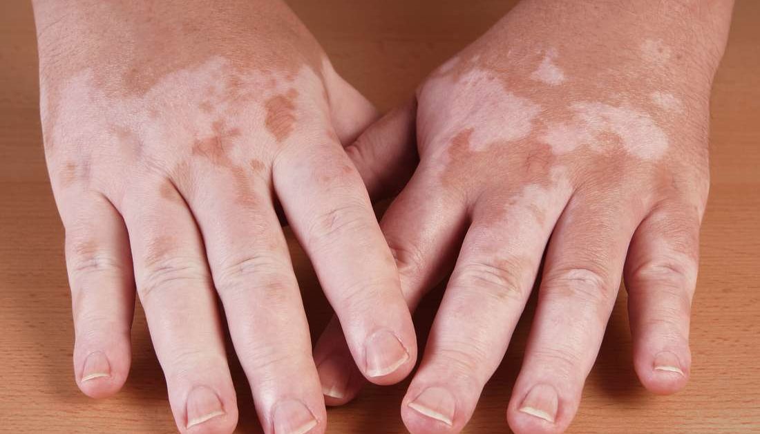 vitiligo